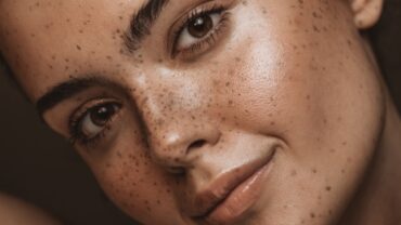 Foto aproximada do rosto de uma mulher com várias manchas na pele, semelhantes a sardas, demonstrando a importância do cuidado com o pH da pele.